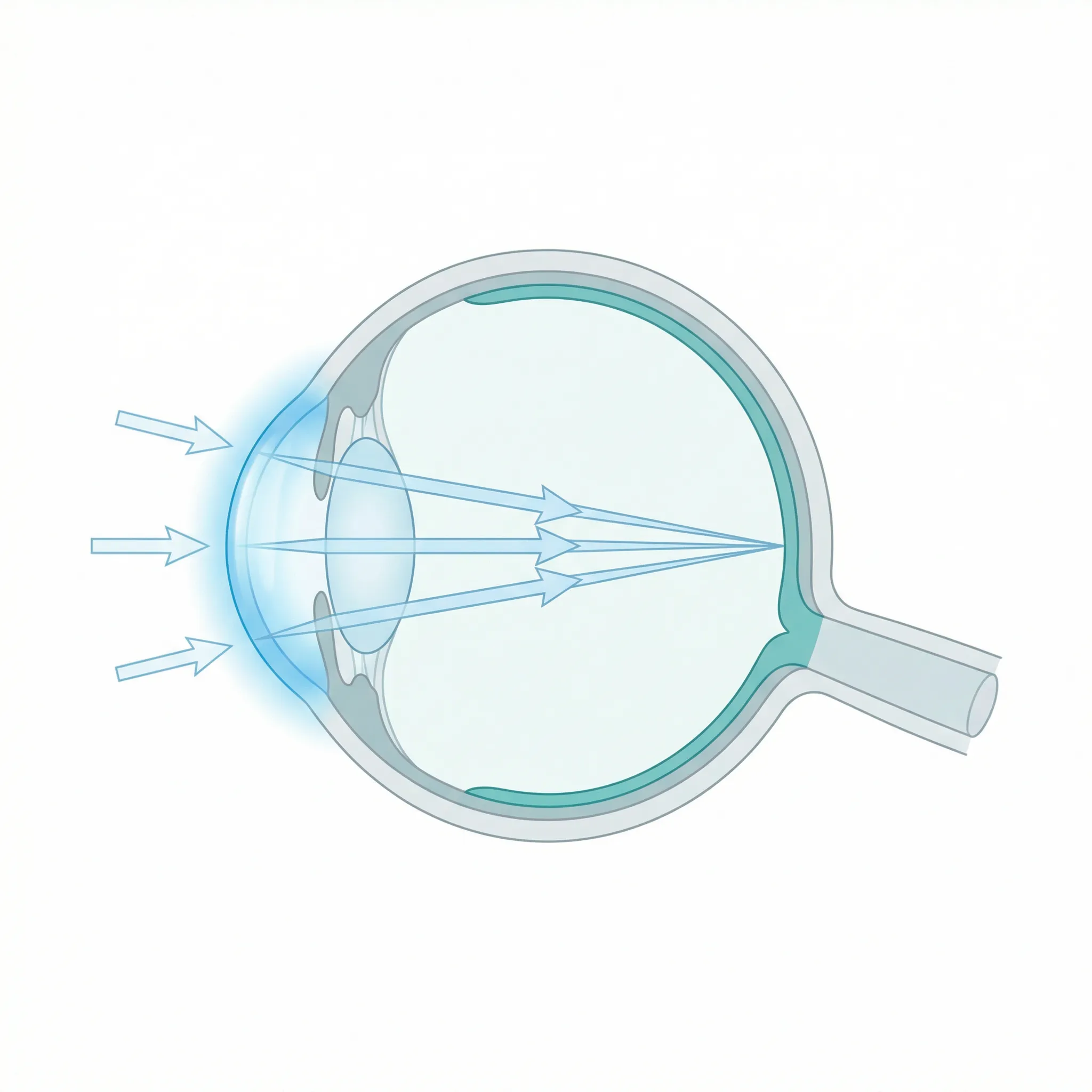 Myopic eye — light focuses in front of retina