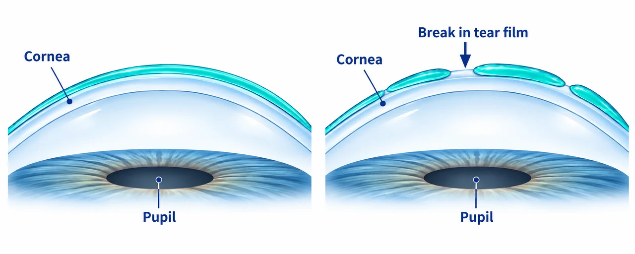 Two schematic corneal surfaces: a continuous turquoise tear-film coating on the left and a patchy coating on the right, with an arrow labeled “Break in tear film” pointing to a gap in the liquid coating. Both diagrams label the cornea and show the iris and labeled pupil below it.